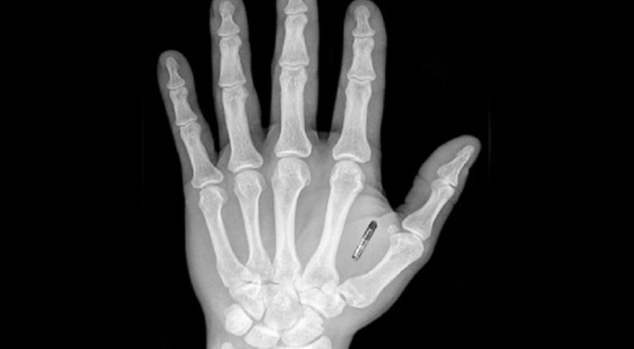 Álemde kompanııalar qyzmetkerlerine mıkrochıp endirýde