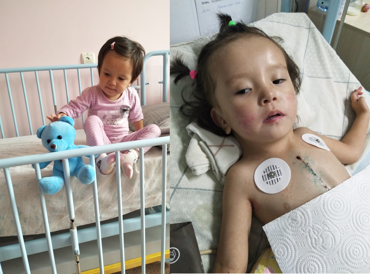 Almatyda júregine operasııa jasatqan balanyń hali aýyr