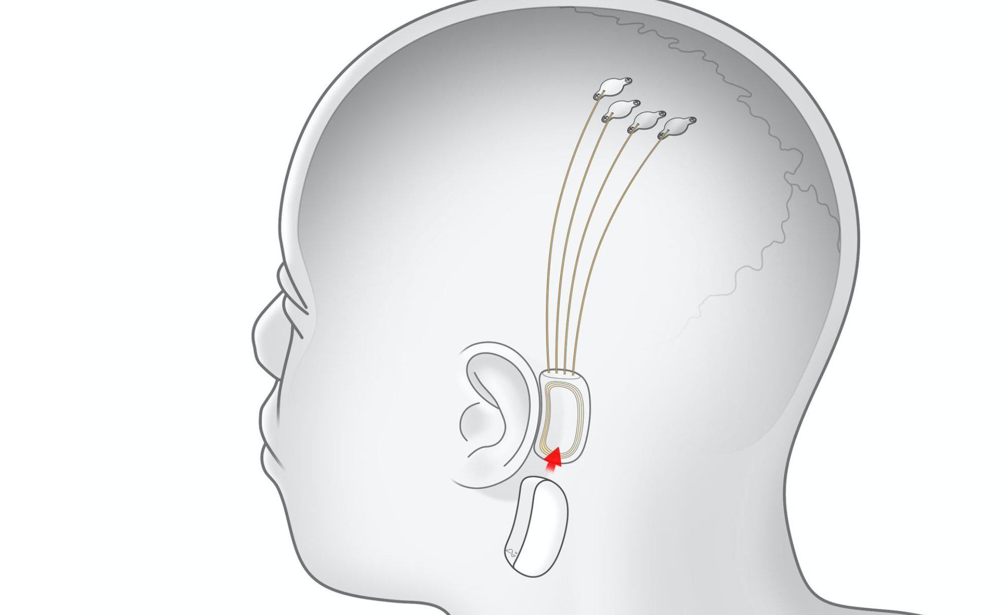 Ilon Masktiń Neuralink jobasy jip ımplanttaryn usyndy