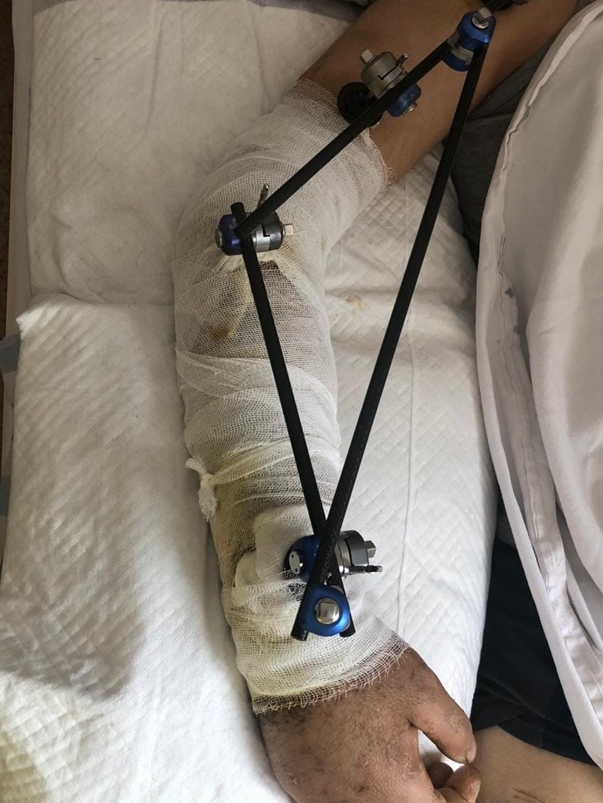 Shymkenttik dárigerler qol súıegi synǵan jigitke kúrdeli ota jasady