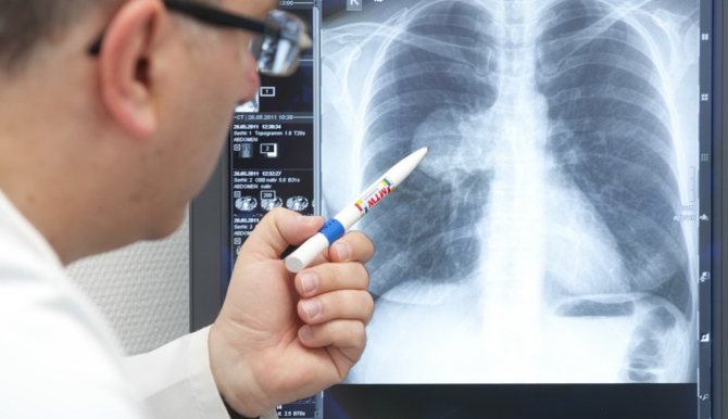 Shymkentte pnevmonııamen aýyrǵan naýqastardyń 80 paıyzy jazylyp shyqty