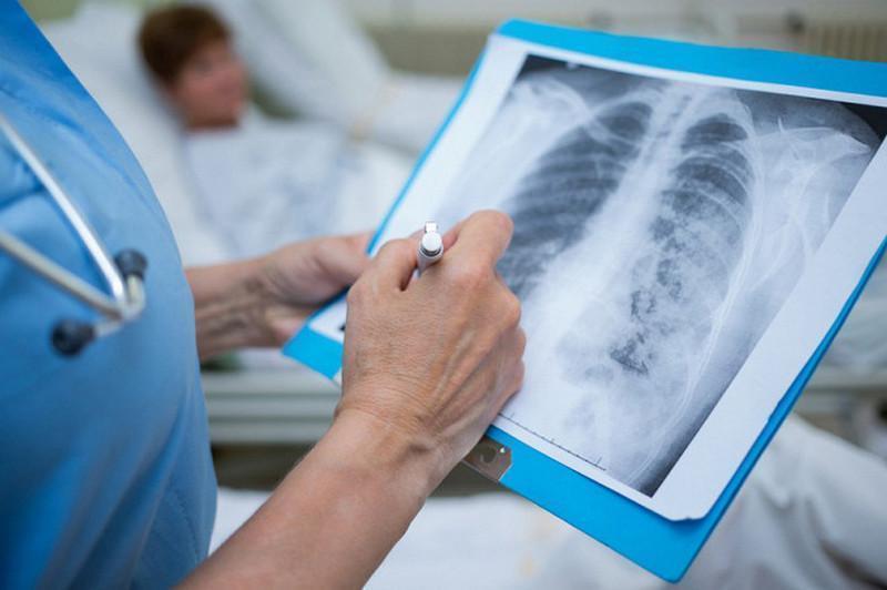 Atyraýda 93 adam koronavırýsqa shaldyǵyp, 92 naýqas saýyǵyp shyqty