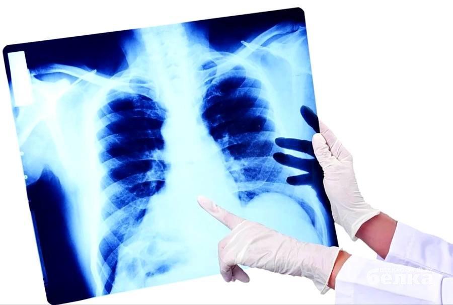 Bir táýlikte 36 adam pnevmonııa dertine shaldyqqan