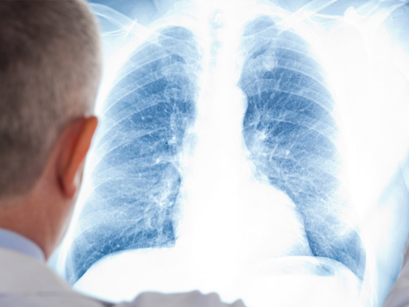 Pnevmonııadan eki azamat kóz jumdy