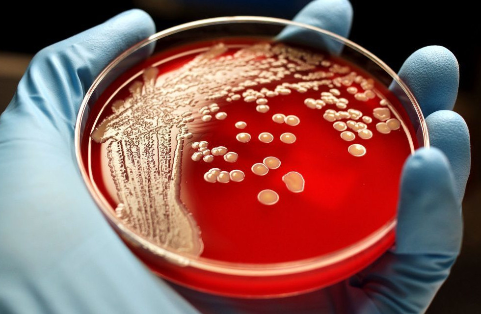 Túrkistan oblysynyń eki turǵynynda sibir jarasy anyqtaldy