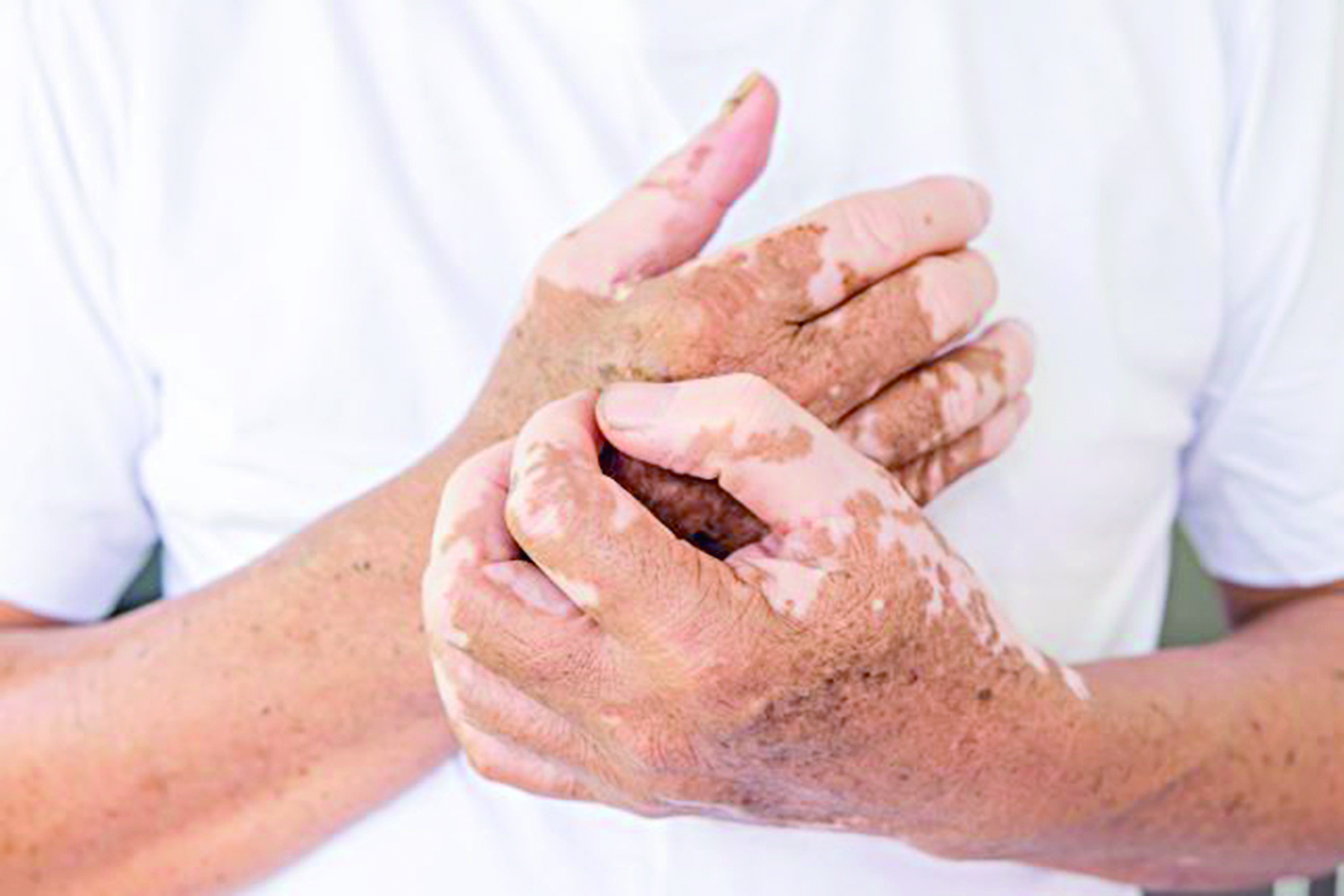 Bes jylda alapes aýrýy tirkelgen joq