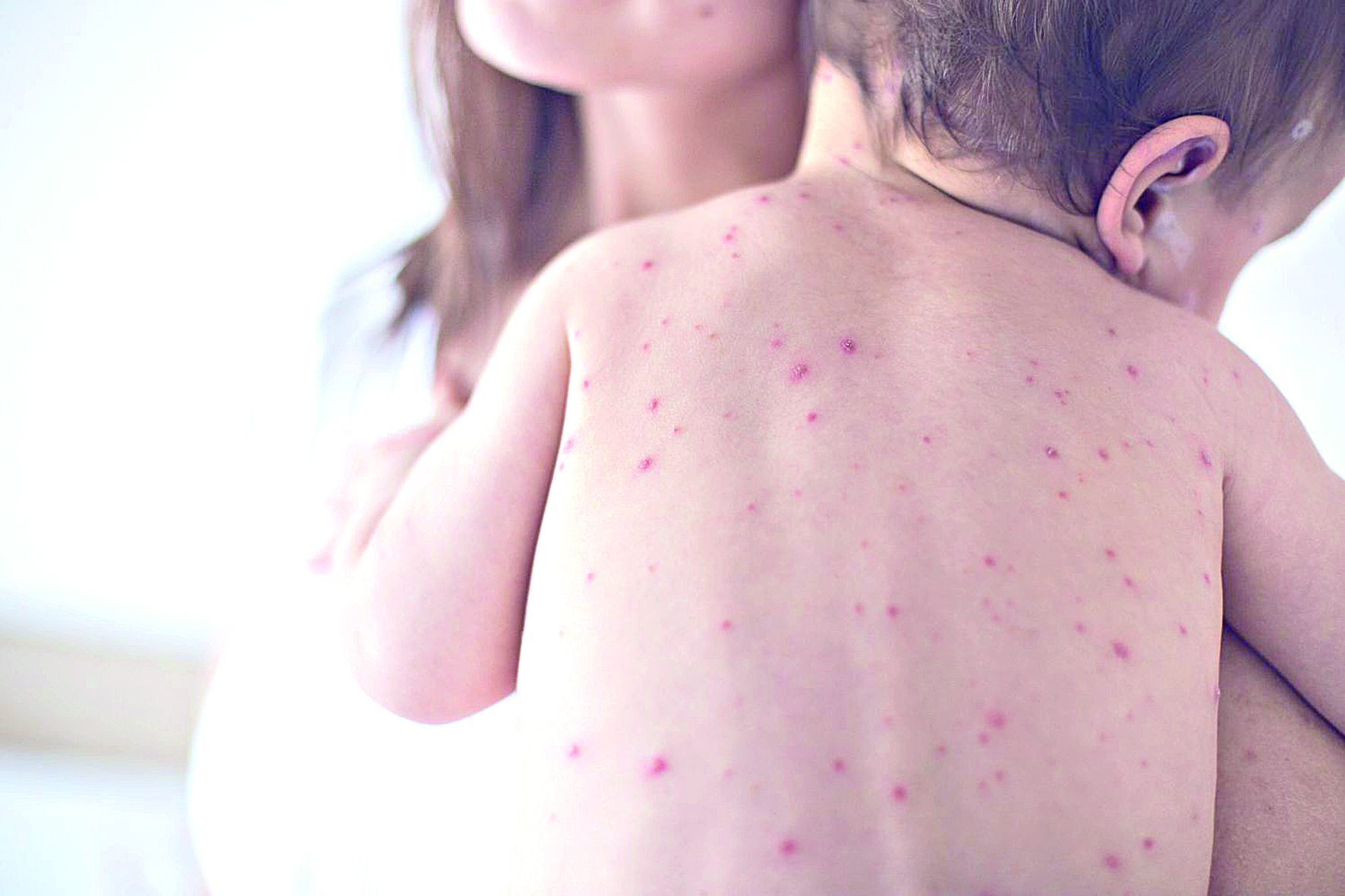 Qyzylsha aýrýynyń sebep-saldary