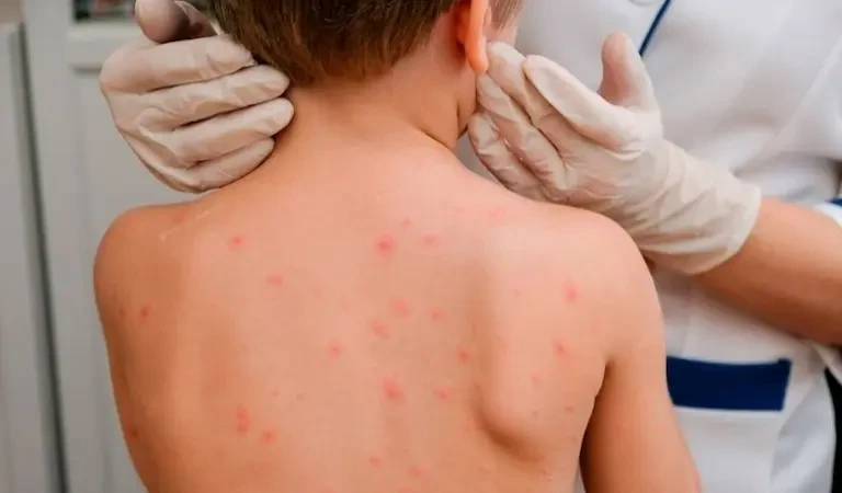 Qyzylshanyń emi qandaı?