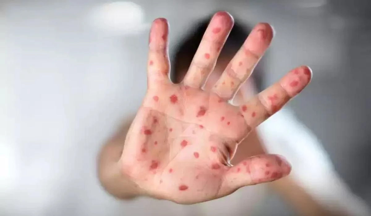 Abaı oblysynyń dárigerleri qyzylshaǵa qarsy vaksııa alýǵa shaqyrdy