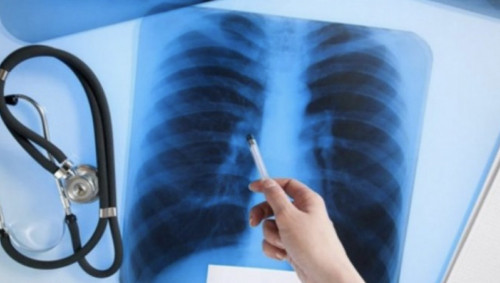 Elimizde týberkýlezben syrqattanýshylar sany azaıǵan