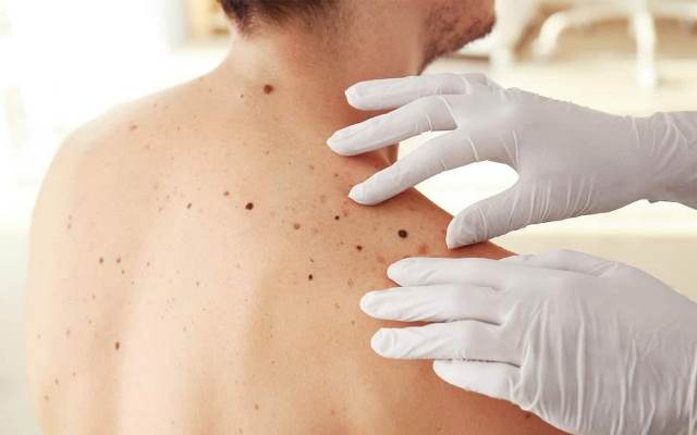 Adam papılloma vırýsy qandaı aýrý