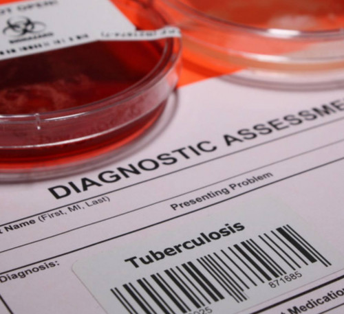 Týberkýlez kezinde koh taıaqshalaryn 2 saǵatta anyqtaýǵa bolady