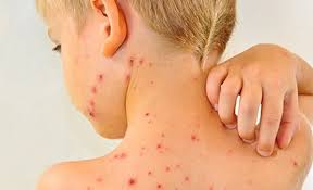 Endi qyzylshaǵa qarsy vaksına mindetti: Astana aýrýhanalaryna bala qabyldaý erejesi ózgerdi