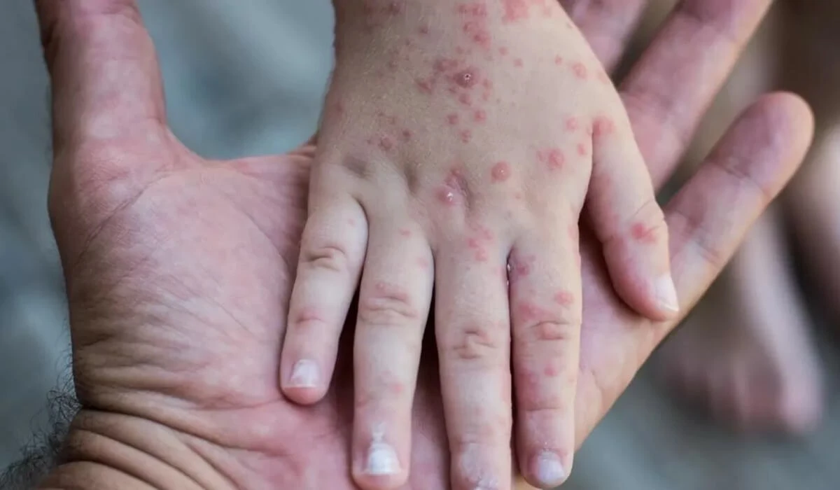 Atyraýda júzdegen adamnyń qyzylsha juqtyrǵany habarlandy