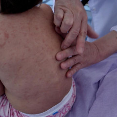 Qyzylsha juqtyrǵan balalar kóbeıgen: Dárigerler ata-analarǵa úndeý jasady